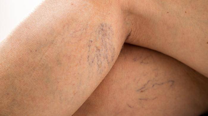 Tips for Preventing Spider Veins