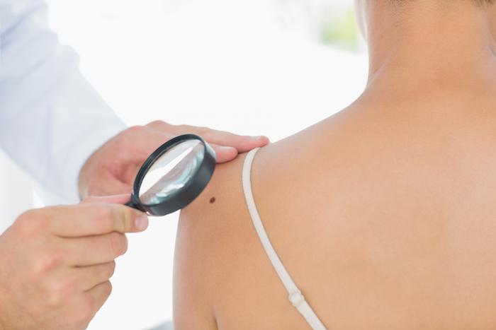 3 Tips for Preventing Skin Cancer